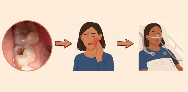 Illustration showing the progression of tooth abscess stages, from tooth decay to severe pain and finally a life-threatening infection requiring hospital care