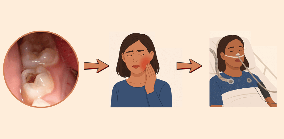 Illustration showing the progression of tooth abscess stages, from tooth decay to severe pain and finally a life-threatening infection requiring hospital care