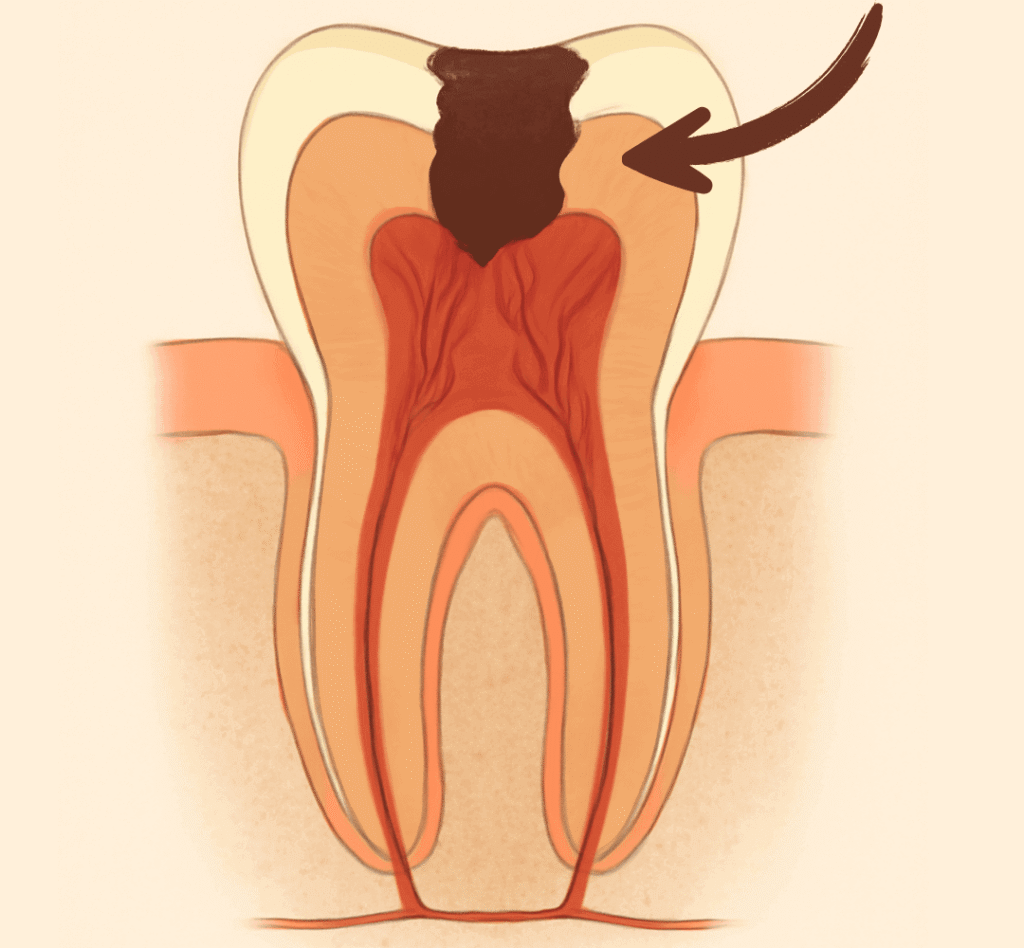 illustration show the infection fully reached the tooth pulp in the second stage of tooth abscess progress